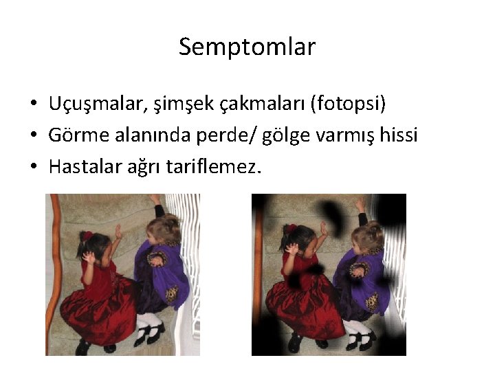 Semptomlar • Uçuşmalar, şimşek çakmaları (fotopsi) • Görme alanında perde/ gölge varmış hissi •