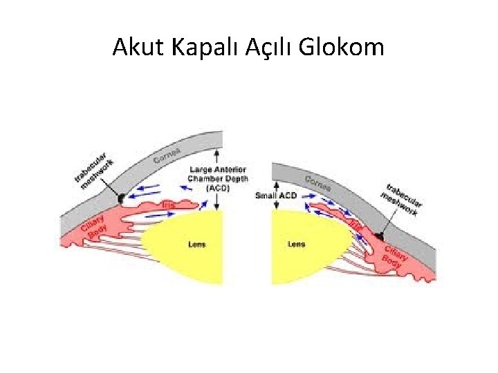 Akut Kapalı Açılı Glokom 