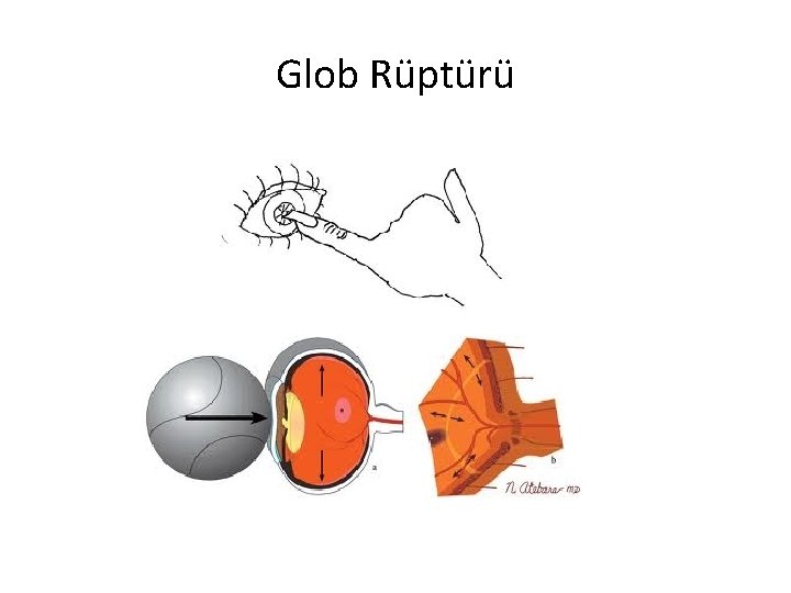 Glob Rüptürü 