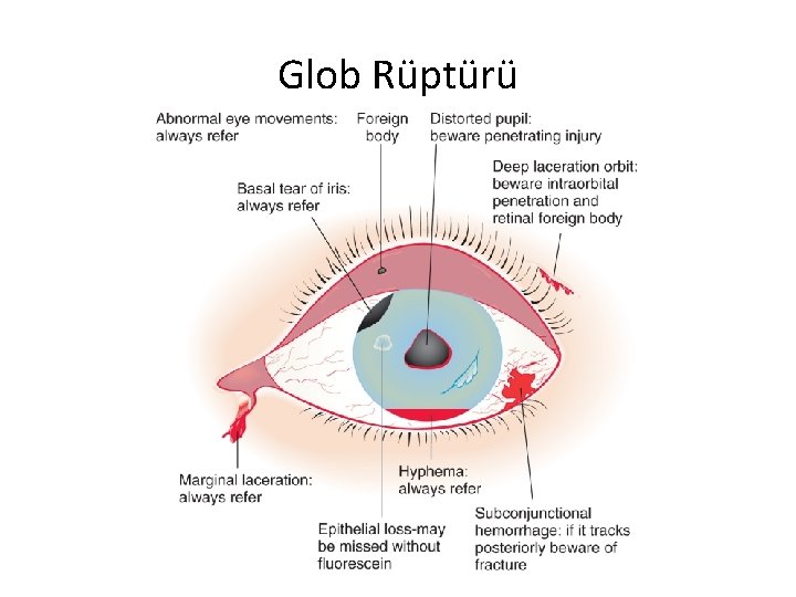 Glob Rüptürü 