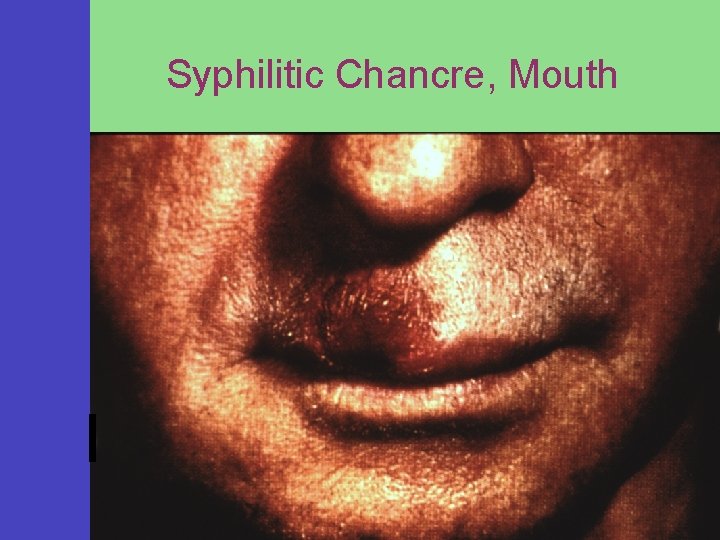 Syphilitic Chancre, Mouth 