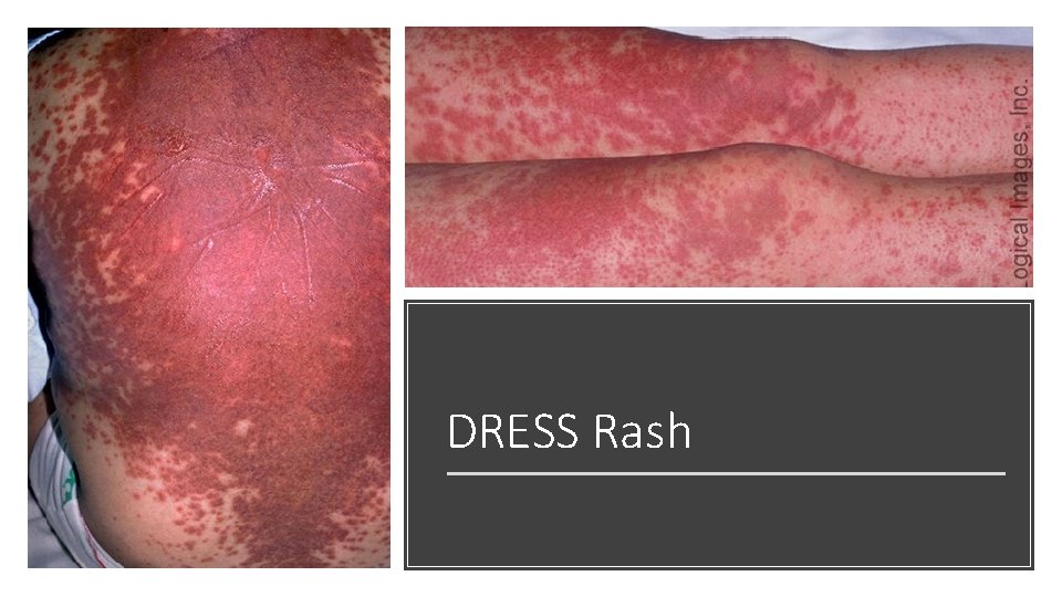 DRESS Rash 