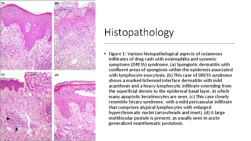 Histopathology • Figure 1: Various histopathological aspects of cutaneous infiltrates of drug rash with