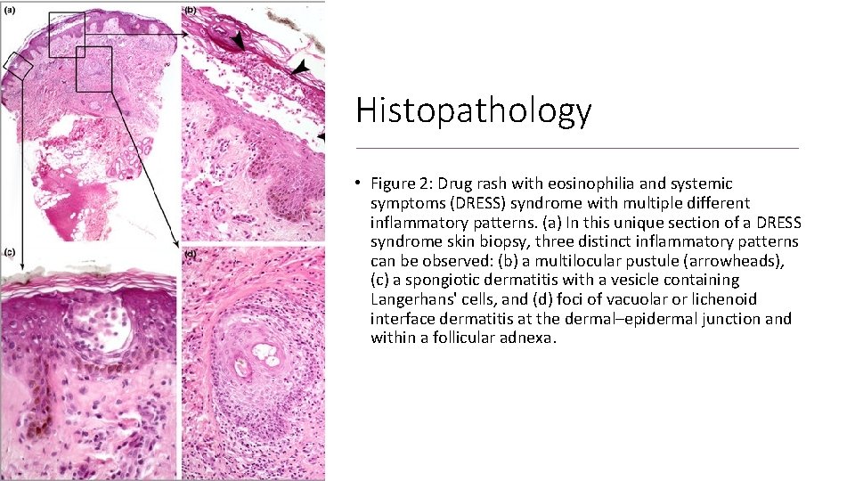 Histopathology • Figure 2: Drug rash with eosinophilia and systemic symptoms (DRESS) syndrome with