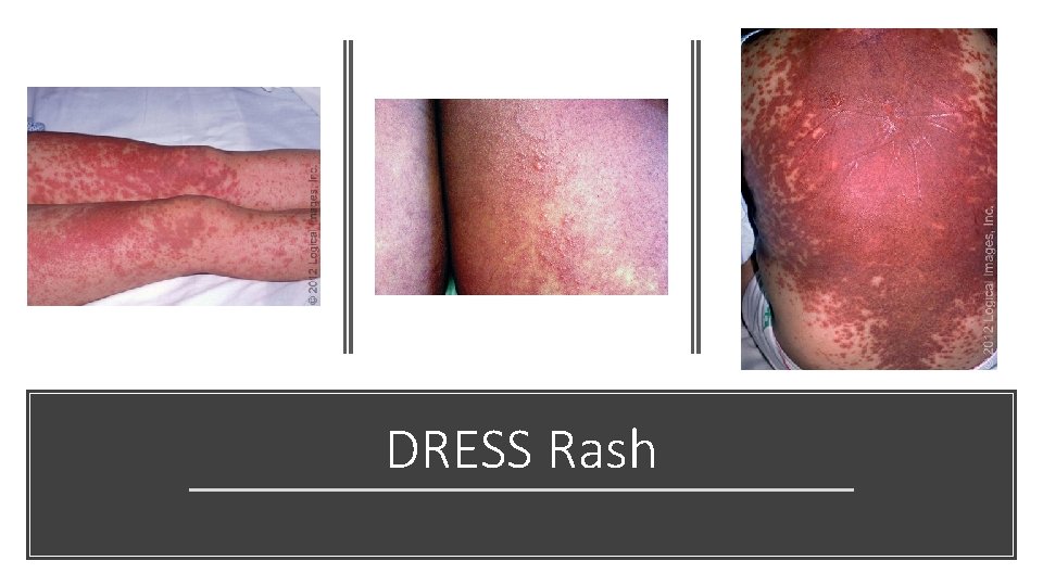 DRESS Rash 