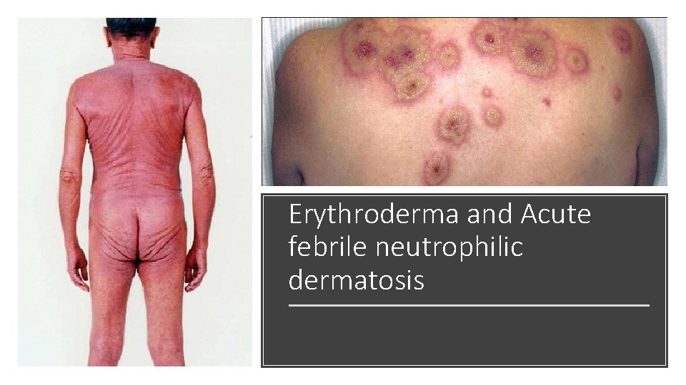 Erythroderma and Acute febrile neutrophilic dermatosis 