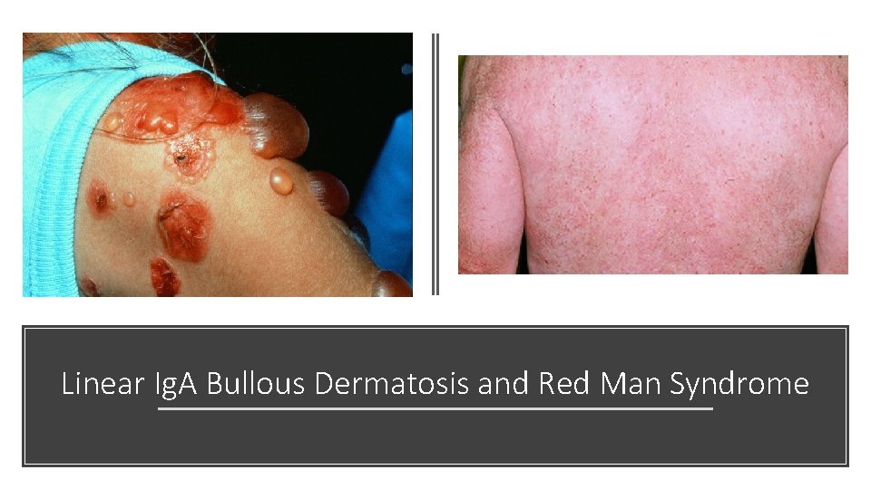 Linear Ig. A Bullous Dermatosis and Red Man Syndrome 