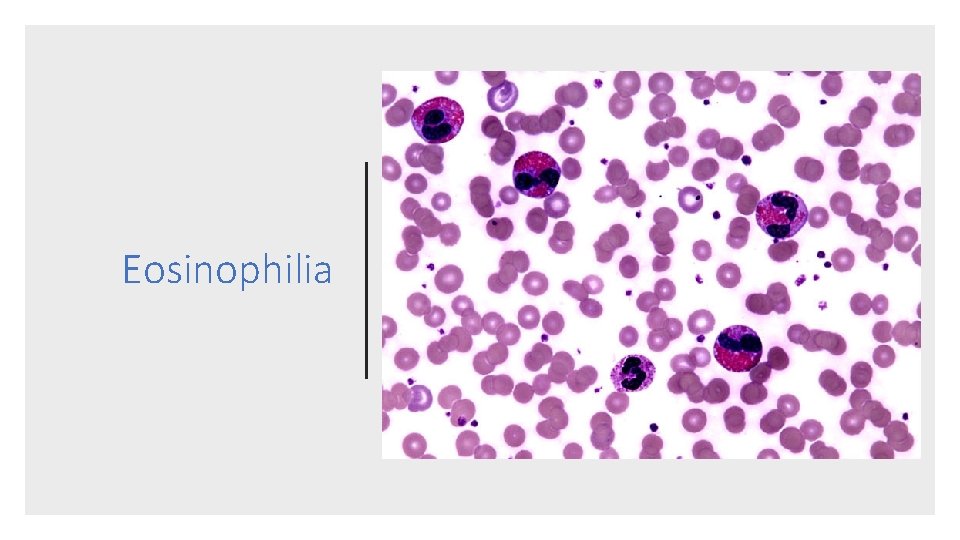 Eosinophilia 