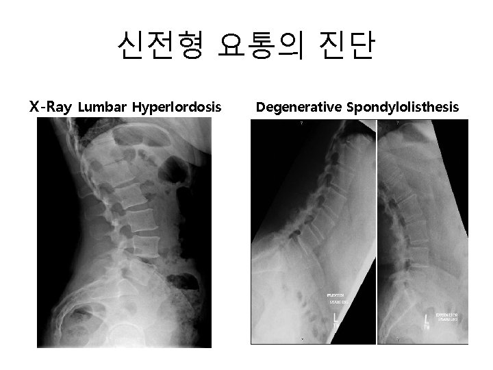 신전형 요통의 진단 X-Ray Lumbar Hyperlordosis Degenerative Spondylolisthesis 