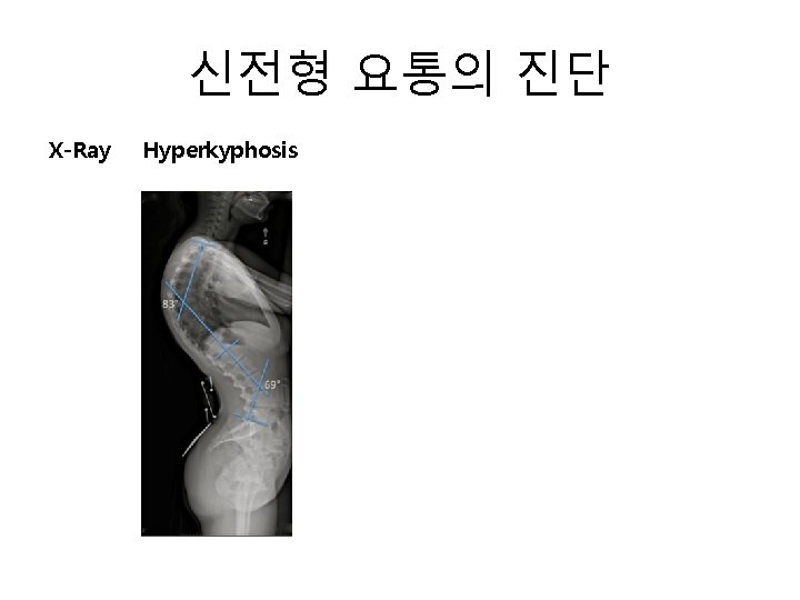 신전형 요통의 진단 X-Ray Hyperkyphosis 