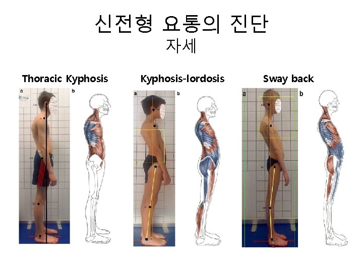 신전형 요통의 진단 자세 Thoracic Kyphosis-lordosis Sway back 