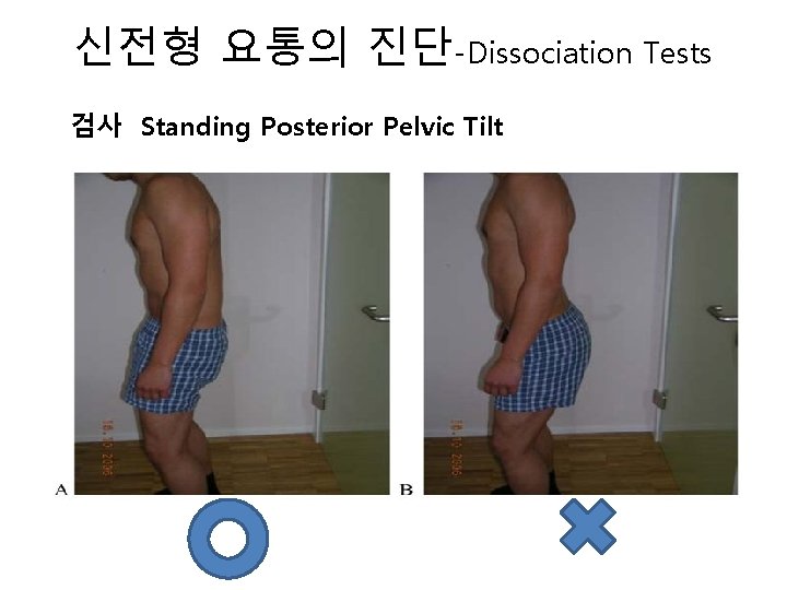 신전형 요통의 진단-Dissociation Tests 검사 Standing Posterior Pelvic Tilt 