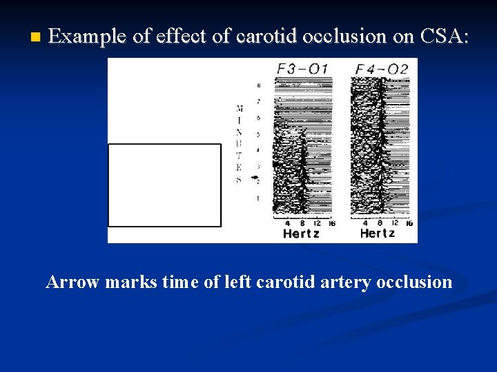  Example of effect of carotid occlusion on CSA: Arrow marks time of left