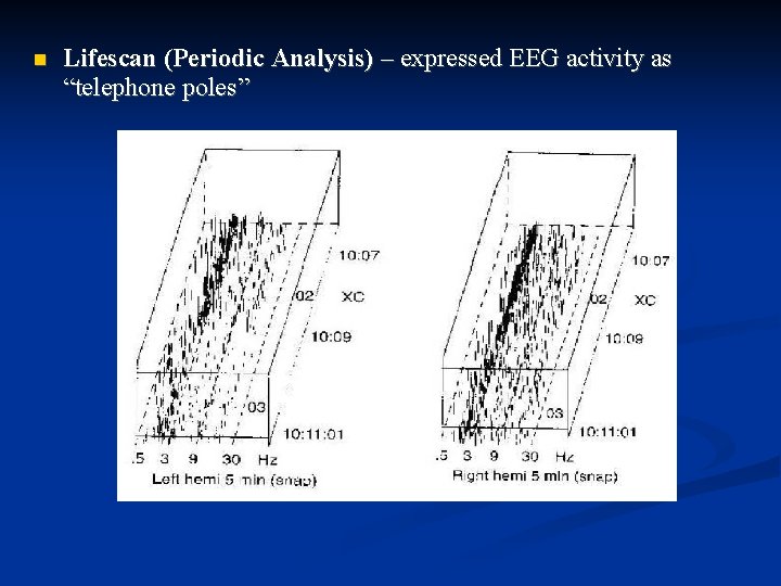  Lifescan (Periodic Analysis) – expressed EEG activity as “telephone poles” 