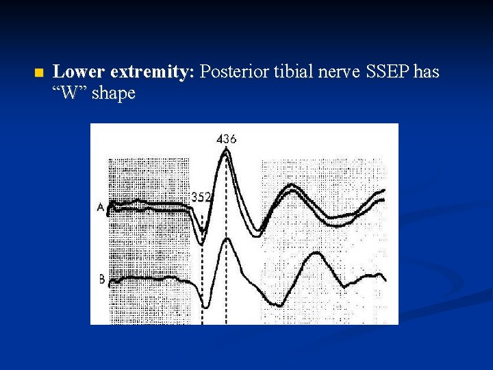  Lower extremity: Posterior tibial nerve SSEP has “W” shape 