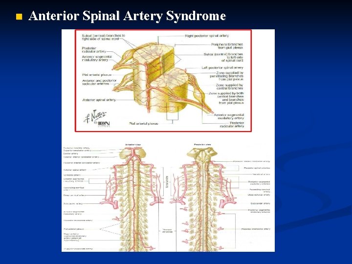  Anterior Spinal Artery Syndrome 