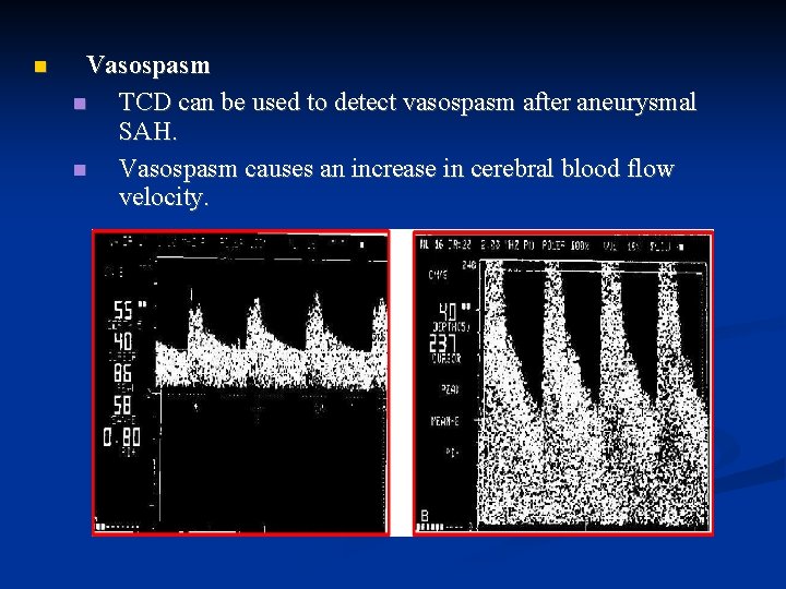  Vasospasm TCD can be used to detect vasospasm after aneurysmal SAH. Vasospasm causes