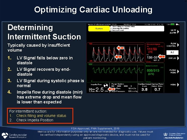 13 Optimizing Cardiac Unloading Determining Intermittent Suction Typically caused by insufficient volume 1. LV 13 Optimizing Cardiac Unloading Determining Intermittent Suction Typically caused by insufficient volume 1. LV