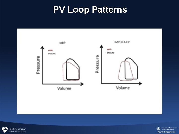 PV Loop Patterns PV Loop Patterns