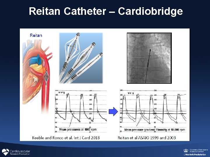 Reitan Catheter – Cardiobridge Reitan Catheter – Cardiobridge