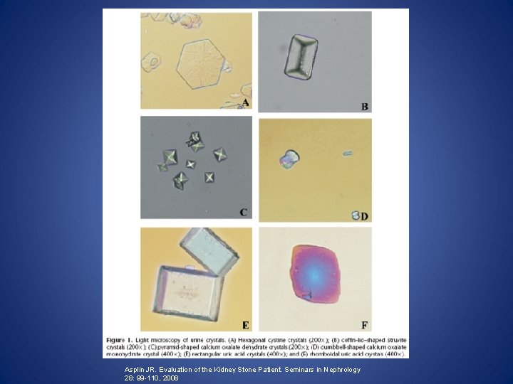 Asplin JR. Evaluation of the Kidney Stone Patient. Seminars in Nephrology 28: 99 -110,