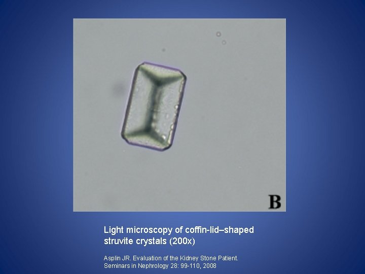 Light microscopy of coffin-lid–shaped struvite crystals (200 x) Asplin JR. Evaluation of the Kidney