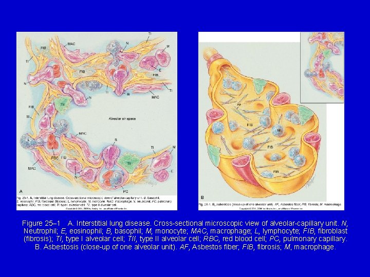 B Figure 25– 1 A. Interstitial lung disease. Cross-sectional microscopic view of alveolar-capillary unit. N,