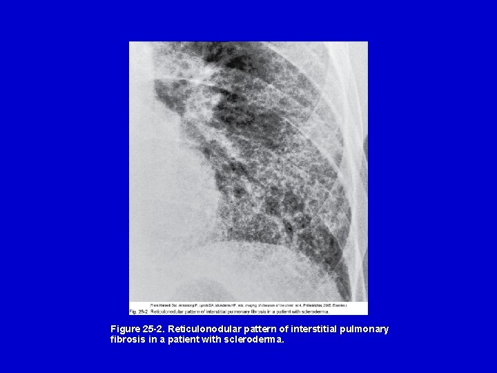 Figure 25 -2. Reticulonodular pattern of interstitial pulmonary fibrosis in a patient with scleroderma.