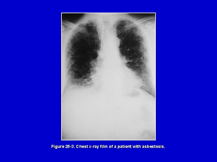 Figure 25 -3. Chest x-ray film of a patient with asbestosis. 