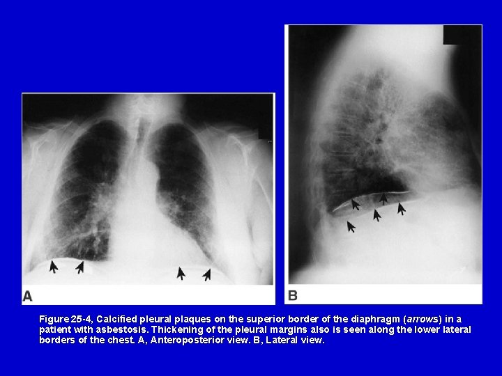 Figure 25 -4, Calcified pleural plaques on the superior border of the diaphragm (