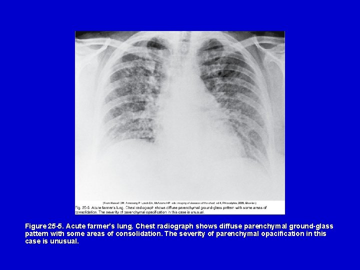 Figure 25 -5. Acute farmer’s lung. Chest radiograph shows diffuse parenchymal ground-glass pattern with