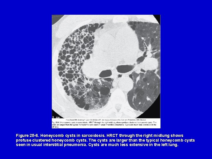 Figure 25 -6. Honeycomb cysts in sarcoidosis. HRCT through the right midlung shows profuse