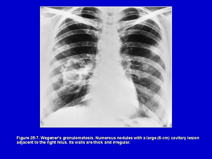 Figure 25 -7. Wegener’s granulomatosis. Numerous nodules with a large (6 -cm) cavitary lesion