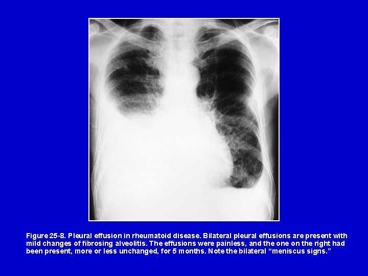 Figure 25 -8. Pleural effusion in rheumatoid disease. Bilateral pleural effusions are present with