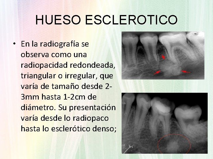 HUESO ESCLEROTICO • En la radiografía se observa como una radiopacidad redondeada, triangular o