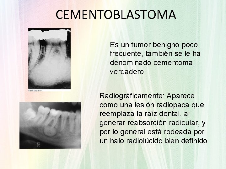CEMENTOBLASTOMA Es un tumor benigno poco frecuente, también se le ha denominado cementoma verdadero CEMENTOBLASTOMA Es un tumor benigno poco frecuente, también se le ha denominado cementoma verdadero