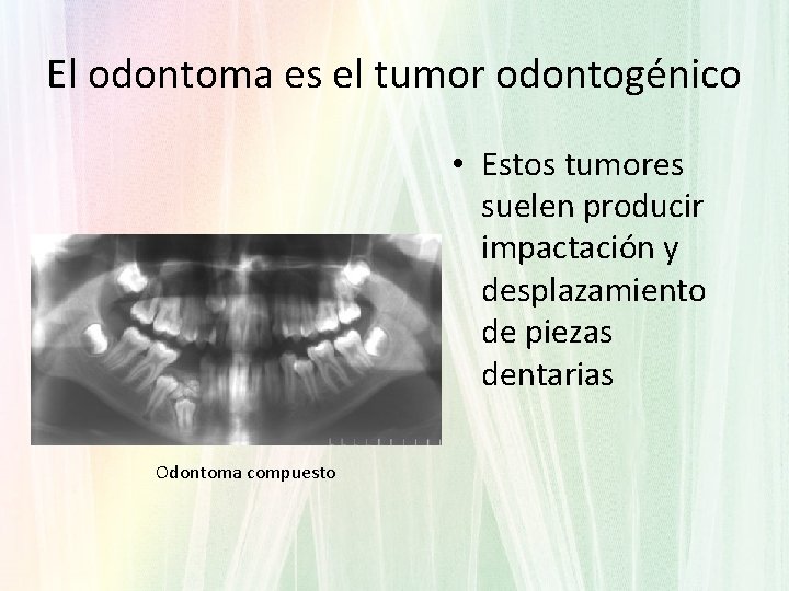 El odontoma es el tumor odontogénico • Estos tumores suelen producir impactación y desplazamiento