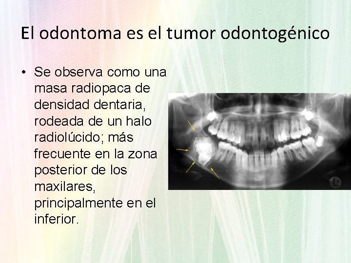 El odontoma es el tumor odontogénico • Se observa como una masa radiopaca de