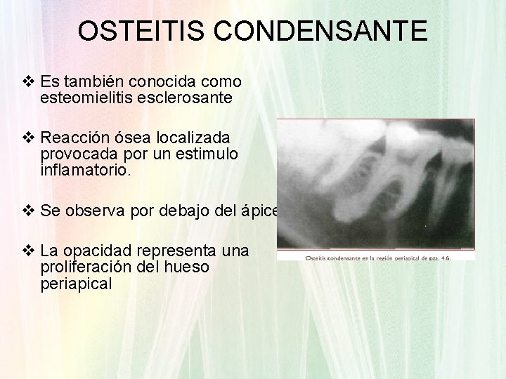 OSTEITIS CONDENSANTE v Es también conocida como esteomielitis esclerosante v Reacción ósea localizada provocada
