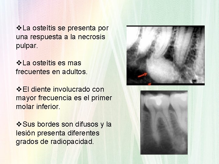 v. La osteítis se presenta por una respuesta a la necrosis pulpar. v. La