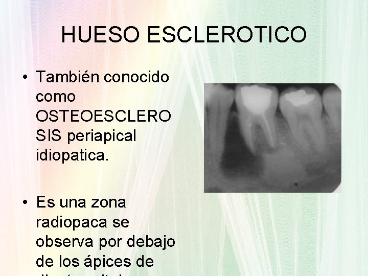 HUESO ESCLEROTICO • También conocido como OSTEOESCLERO SIS periapical idiopatica. • Es una zona HUESO ESCLEROTICO • También conocido como OSTEOESCLERO SIS periapical idiopatica. • Es una zona