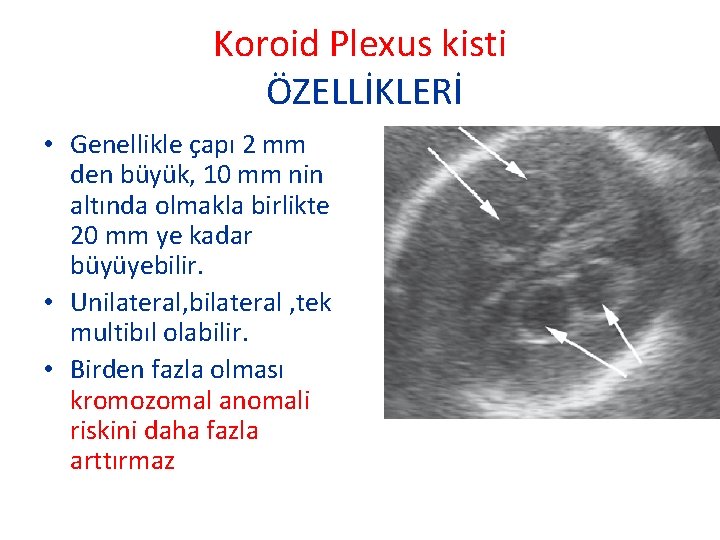 Koroid Plexus kisti ÖZELLİKLERİ • Genellikle çapı 2 mm den büyük, 10 mm nin