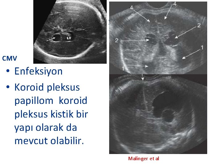 s CMV • Enfeksiyon • Koroid pleksus papillom koroid pleksus kistik bir yapı olarak