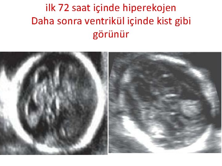 ilk 72 saat içinde hiperekojen Daha sonra ventrikül içinde kist gibi görünür 