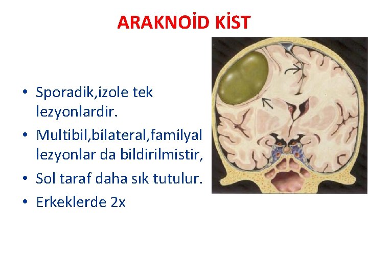ARAKNOİD KİST • Sporadik, izole tek lezyonlardir. • Multibil, bilateral, familyal lezyonlar da bildirilmistir,