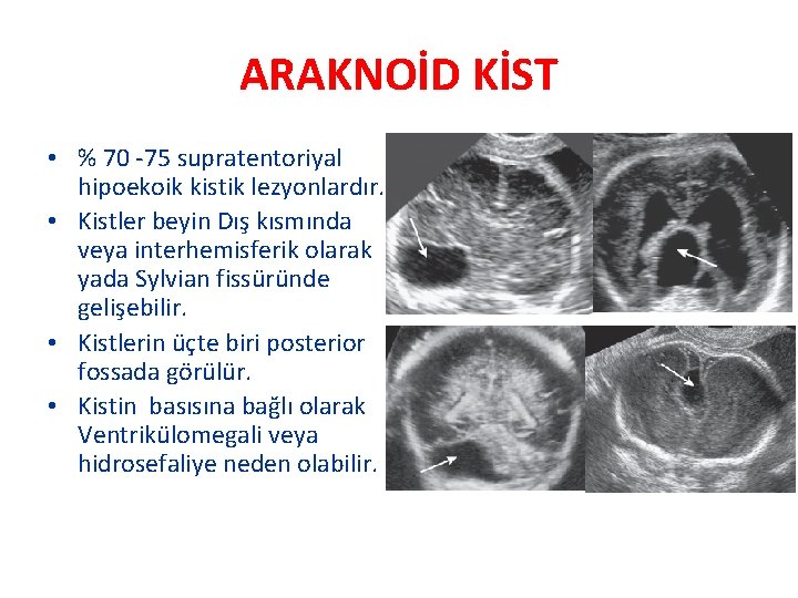 ARAKNOİD KİST • % 70 -75 supratentoriyal hipoekoik kistik lezyonlardır. • Kistler beyin Dış