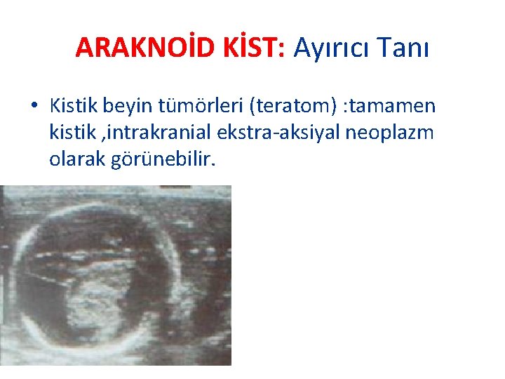 ARAKNOİD KİST: Ayırıcı Tanı • Kistik beyin tümörleri (teratom) : tamamen kistik , intrakranial