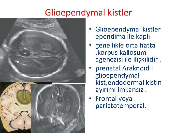 Glioependymal kistler • Glioependymal kistler ependima ile kaplı • genellikle orta hatta , korpus