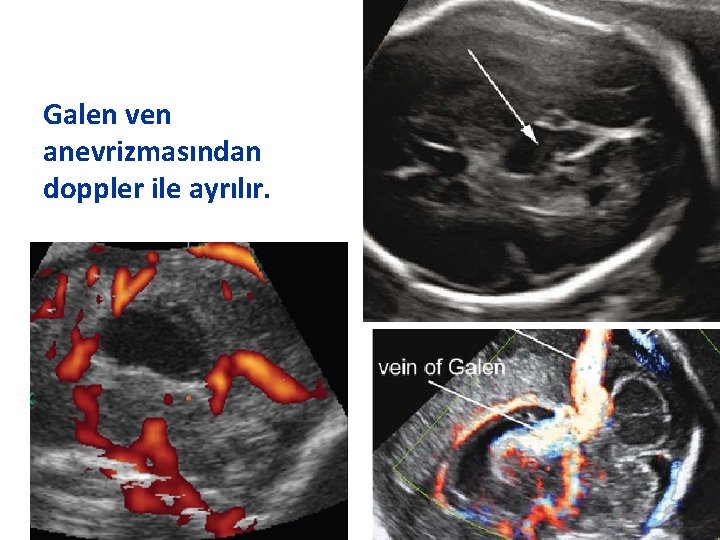 Galen ven anevrizmasından doppler ile ayrılır. 