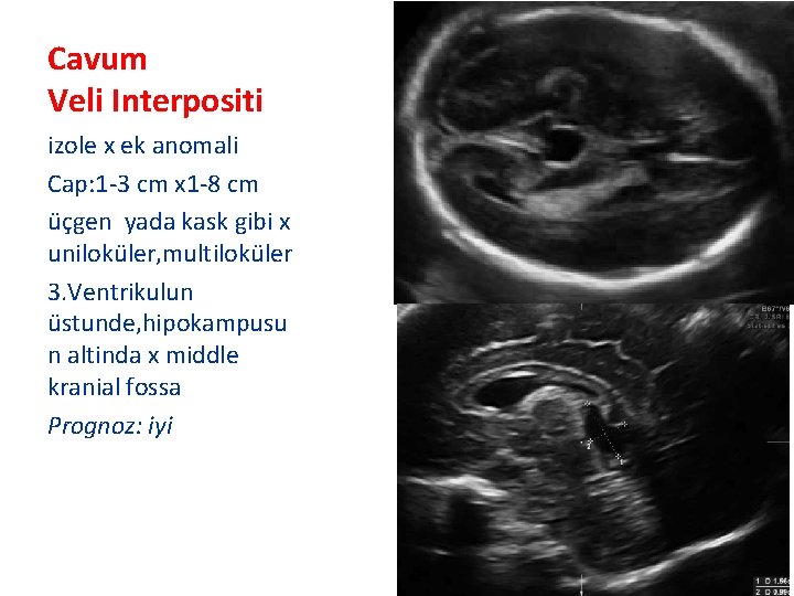 Cavum Veli Interpositi izole x ek anomali Cap: 1 -3 cm x 1 -8